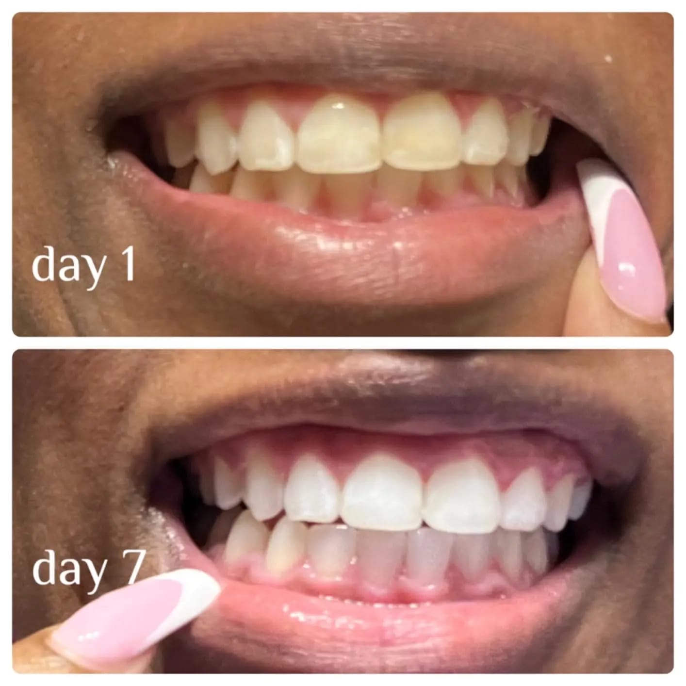 Customer photo review of Novelix™ Whitening Pen