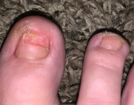 Customer photo review of FungalFix™ - Fungal Nail Renewal Patches