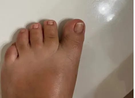 Customer photo review of FungalFix™ - Fungal Nail Renewal Patches