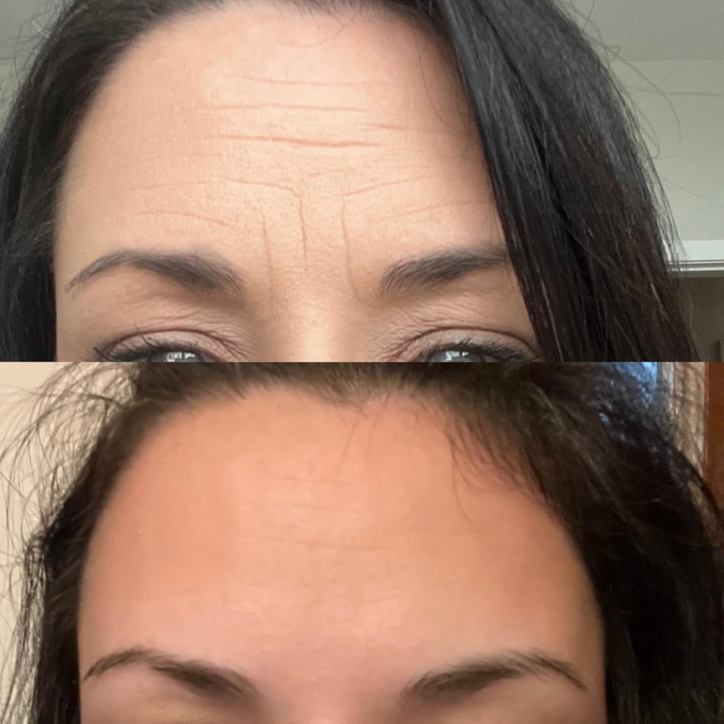 Customer photo review of Superlift пластири за бръчки