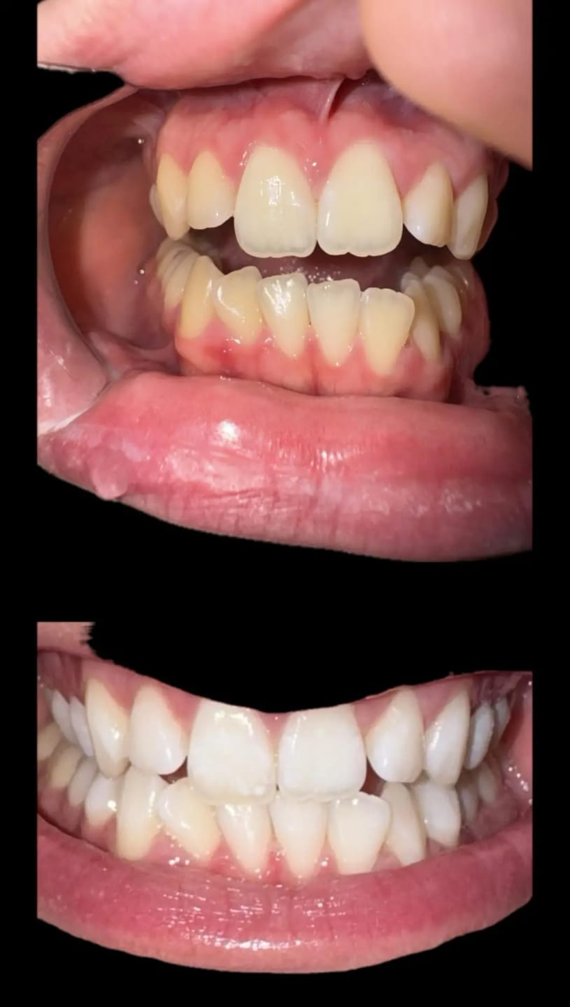 Customer photo review of Novelix™ Whitening Pen
