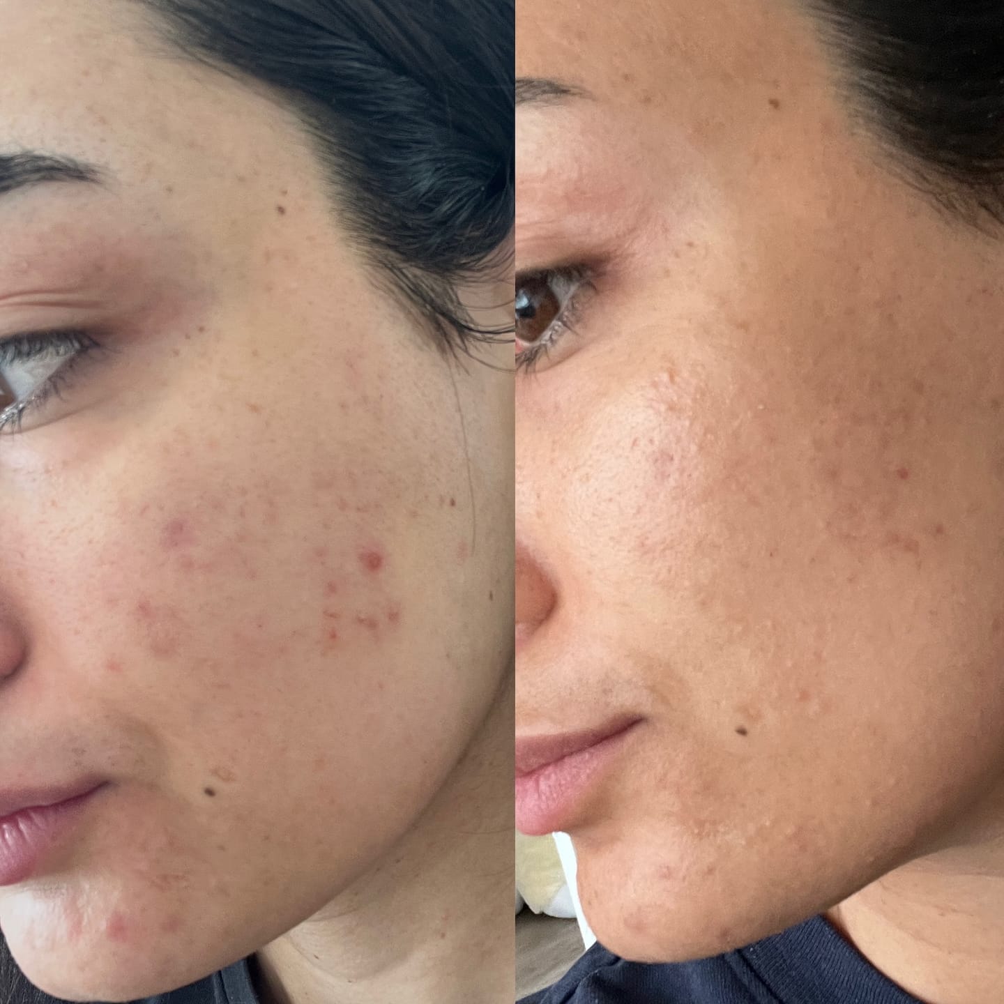 Customer photo review of Kill Acne & Redness Ritual