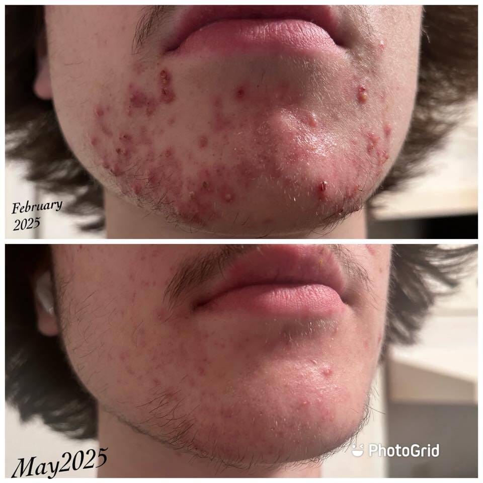 Customer photo review of Kill Acne & Redness Ritual