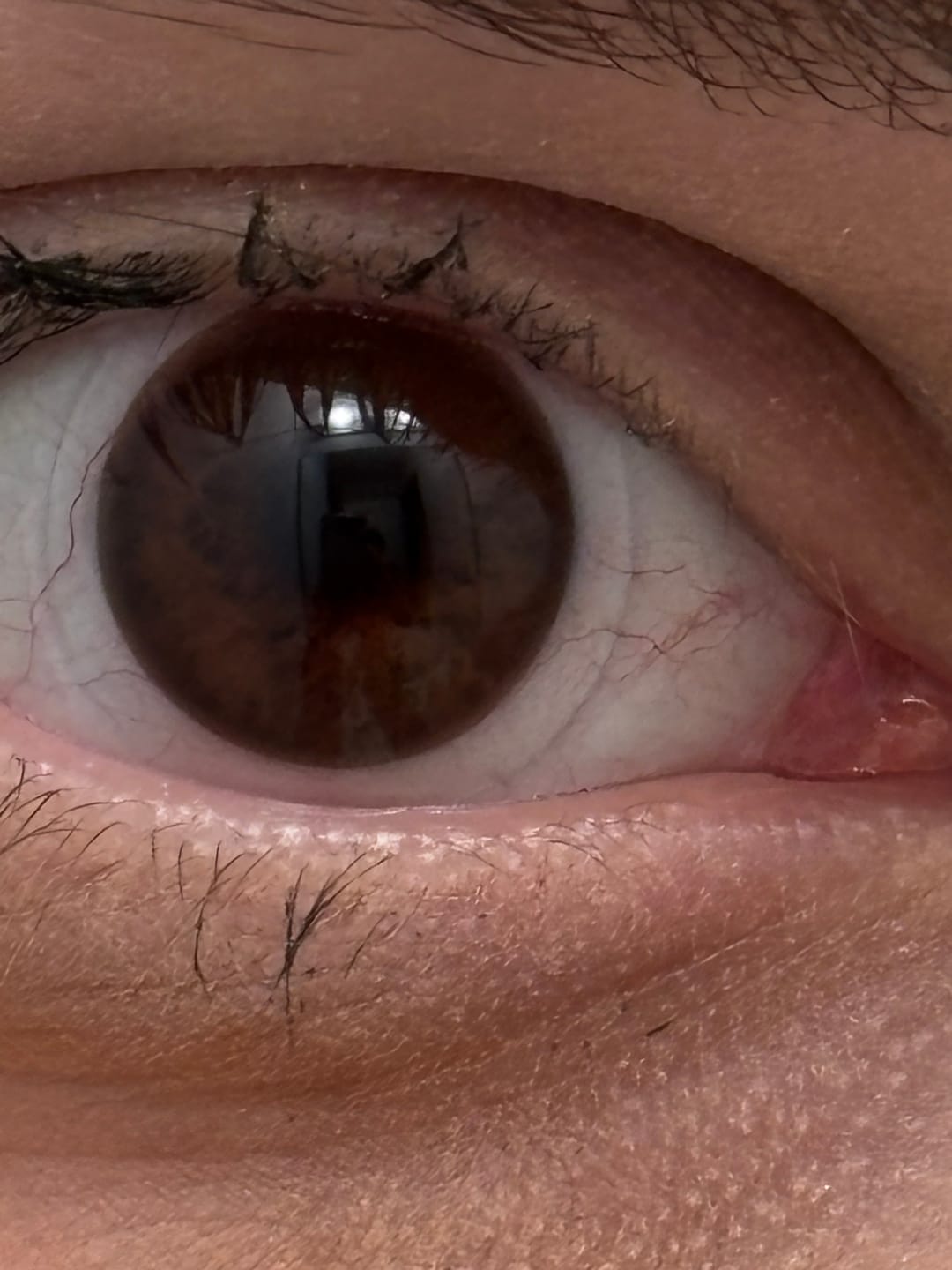 Customer photo review of Eyeling Custom Lens (6 months)