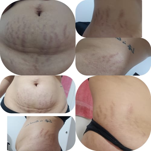 Customer photo review of Crema AntiCelulitis🧴🦵 - 200ml EMILY