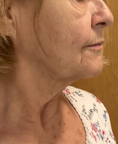 Customer photo review of EvenSkyn® Venus: Advanced Eyelid Anti-Aging Device