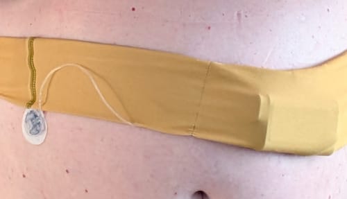 Customer photo review of Universal Insulin Pump Waistbelt - Dia-BellyBand SOLID COLORS