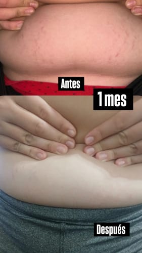 Customer photo review of Crema AntiEstrías🧴🦵 - 200ml EMILY