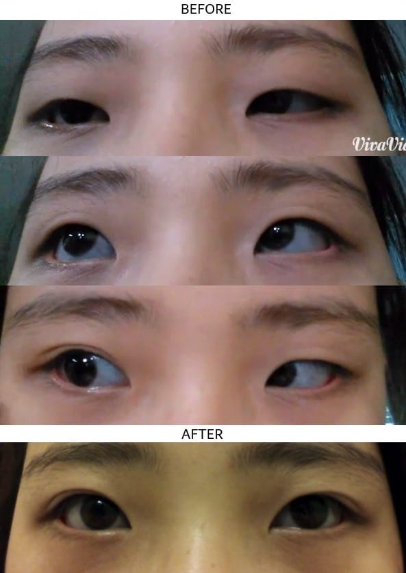 Customer photo review of Optifold EyelidShaping™ Tapes (Standard Pack)