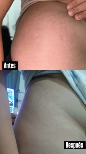 Customer photo review of Crema AntiEstrías🧴🦵 - 200ml EMILY