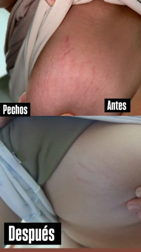 Customer photo review of Crema AntiEstrías🧴🦵 - 200ml EMILY