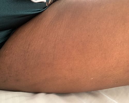 Customer photo review of Anti-Acne & Dark Spots African Soap