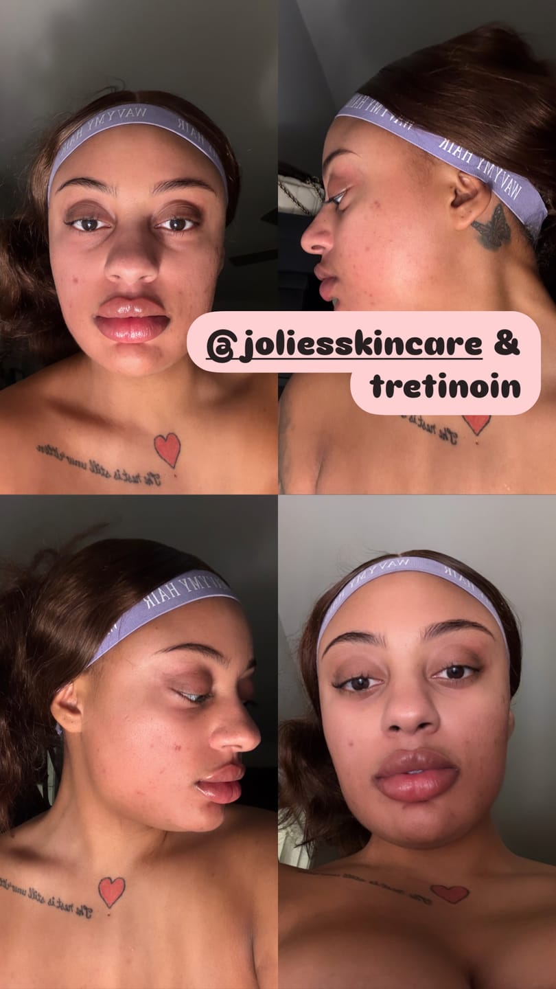 Customer photo review of LIMITED EDITION: Jolie’s Mini Full Body & Face Brightening Kit/ Acne Kit