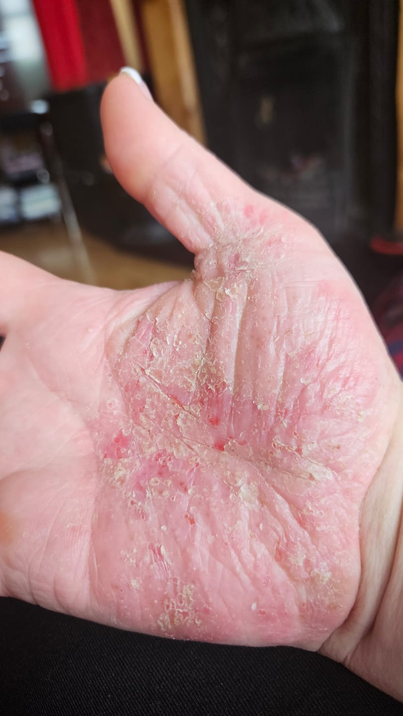 Customer photo review of Bioskin Duo Pack