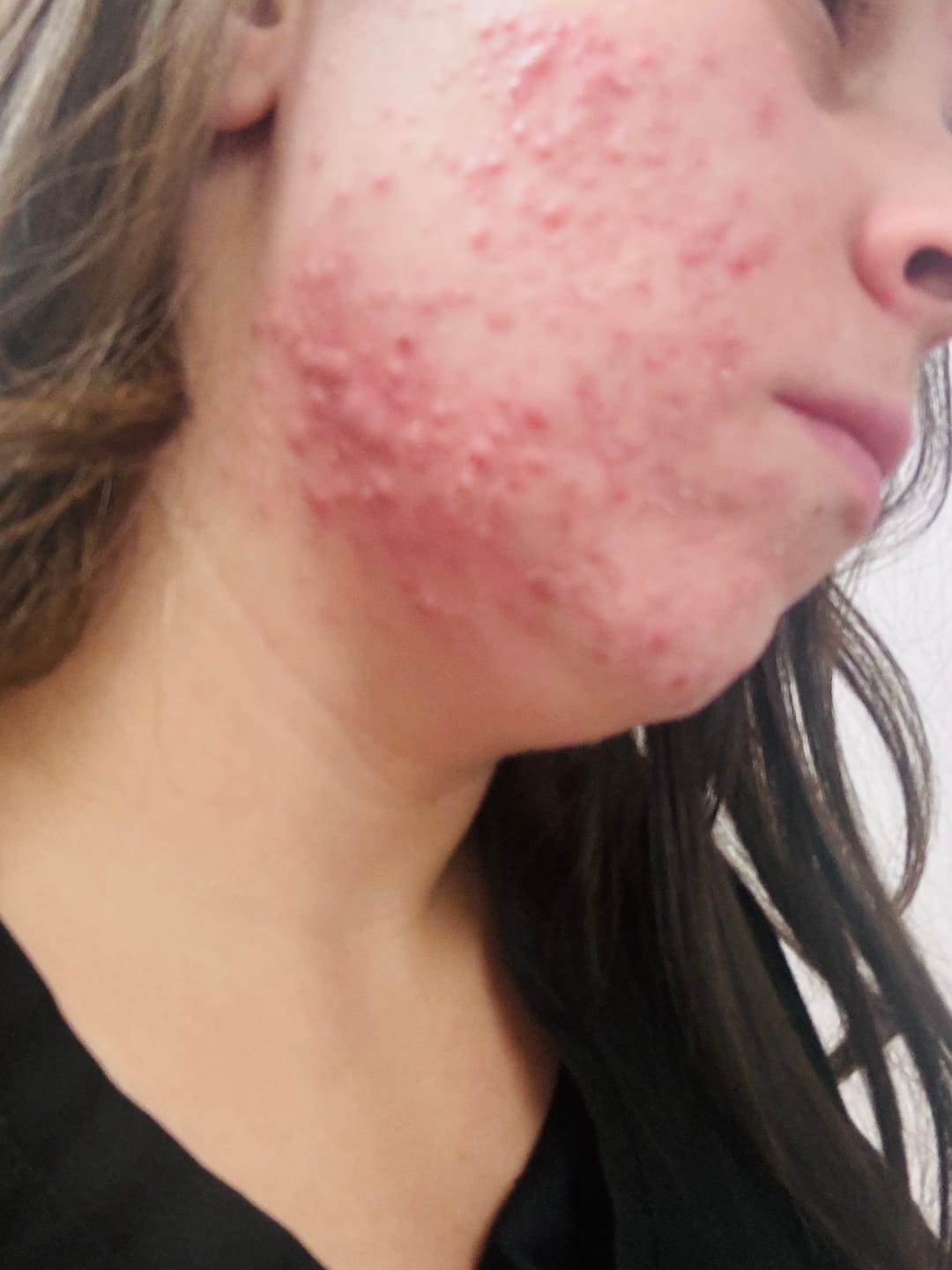 Customer photo review of The Complete Acne System for Women
