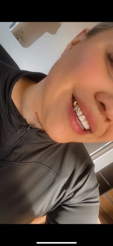Customer photo review of PRISM (GOLD PLATED GRILLZ)