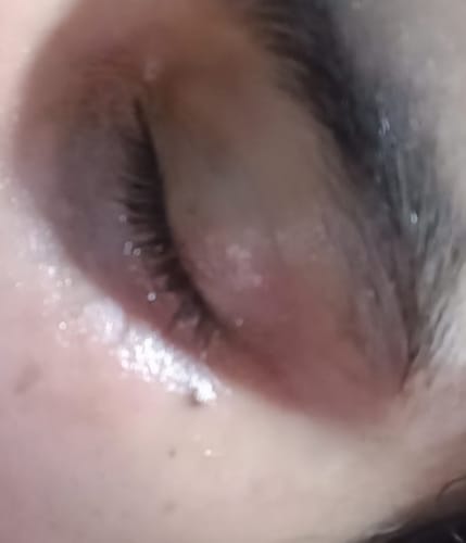 Customer photo review of BAKUCHIOL RESURFACING NIGHT SERUM - with 10% Lactic Acid