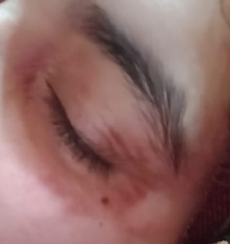 Customer photo review of BAKUCHIOL RESURFACING NIGHT SERUM - with 10% Lactic Acid