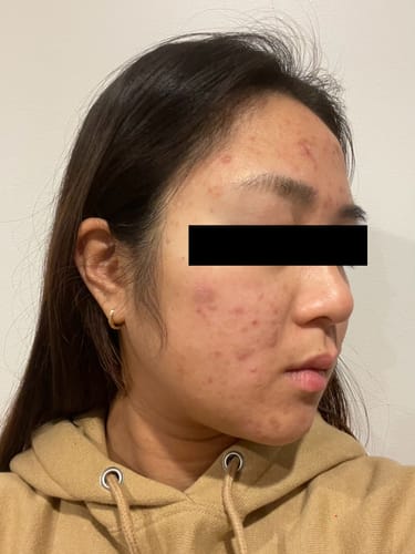 Customer photo review of VT Cosmetics - Cica Spot Patch 48pcs