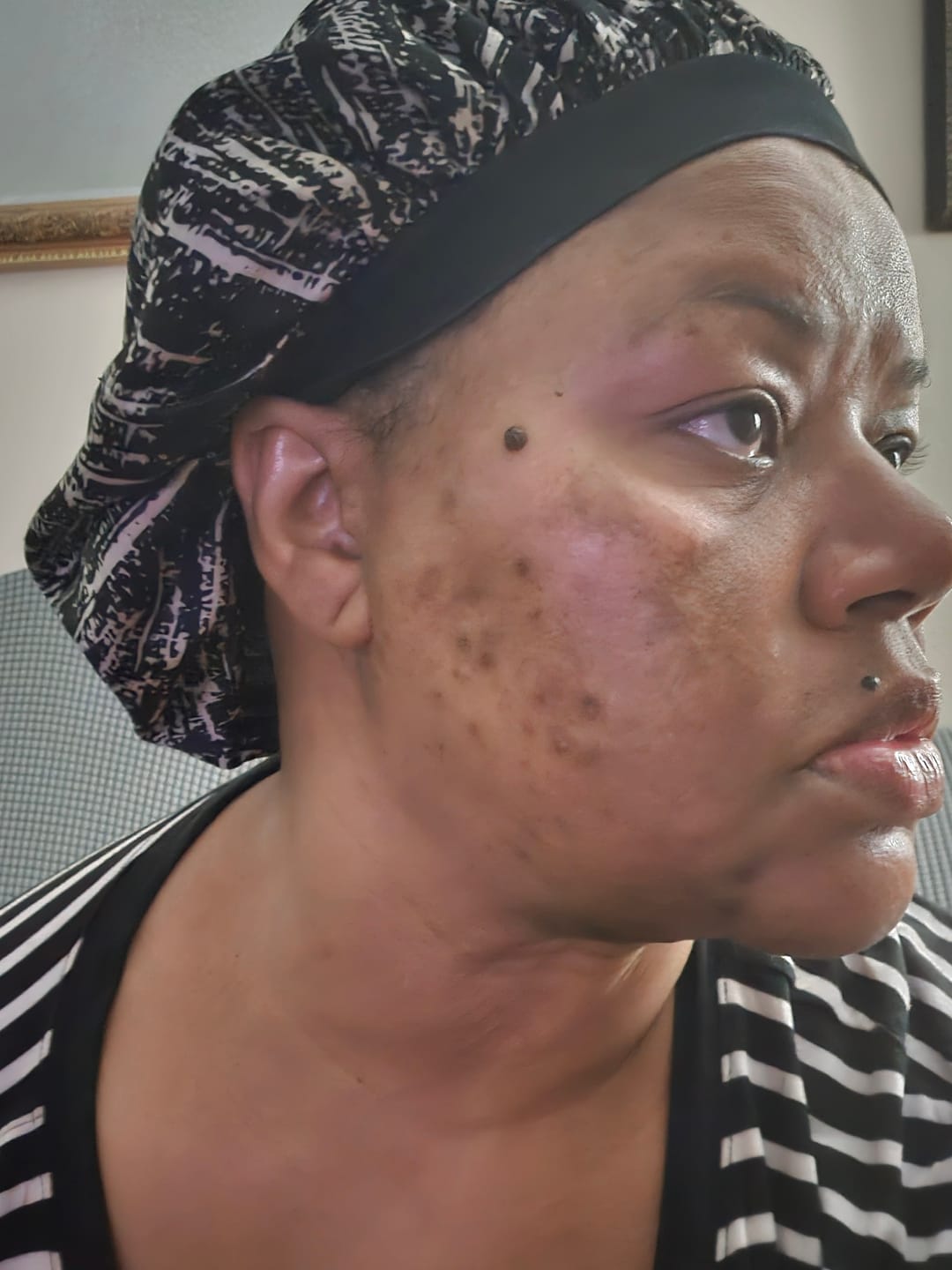 Customer photo review of LIMITED EDITION: Jolie’s Mini Full Body & Face Brightening Kit/ Acne Kit