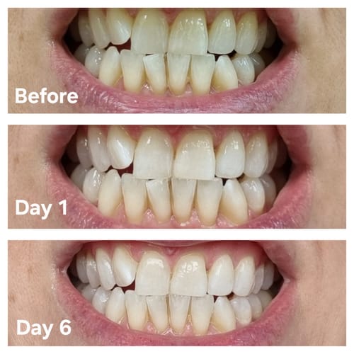 Customer photo review of Teeth Whitening Strips