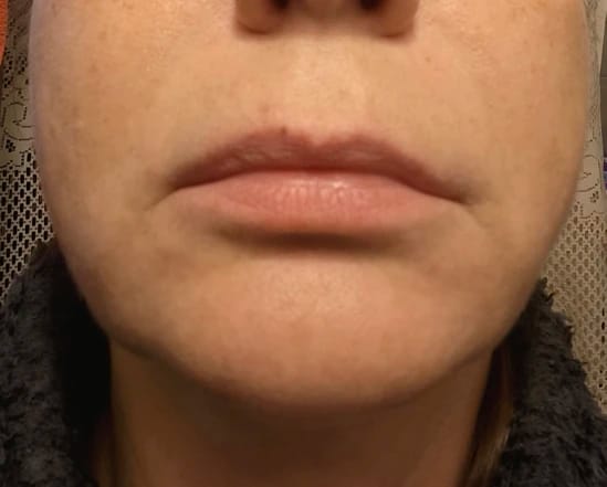 Customer photo review of Bellaré -  Lip Plumper