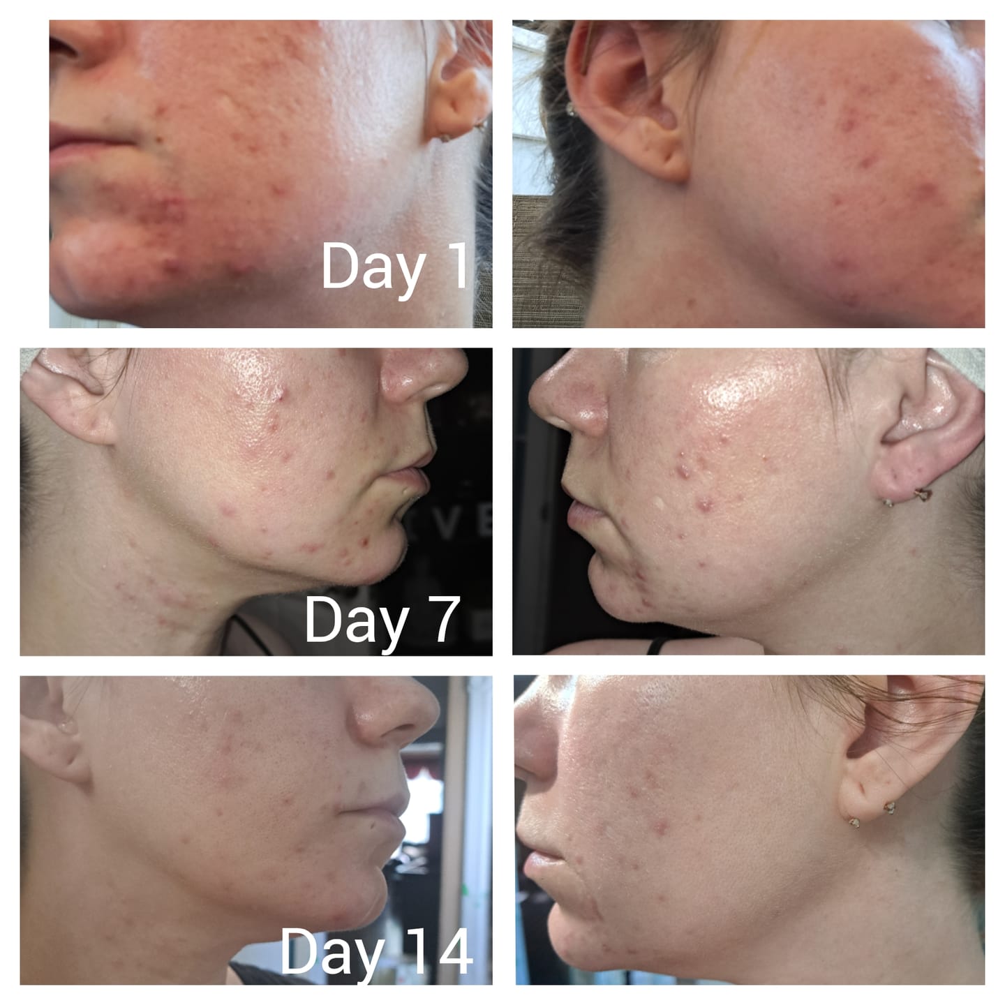 Customer photo review of Kill Acne & Redness Ritual