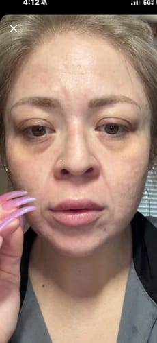 Customer photo review of INIA FLARE Microcurrent Facial Device