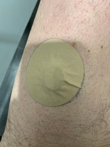 Customer photo review of Skin Grip MAX Dexcom G7 & Stelo Patches - 10 Pack