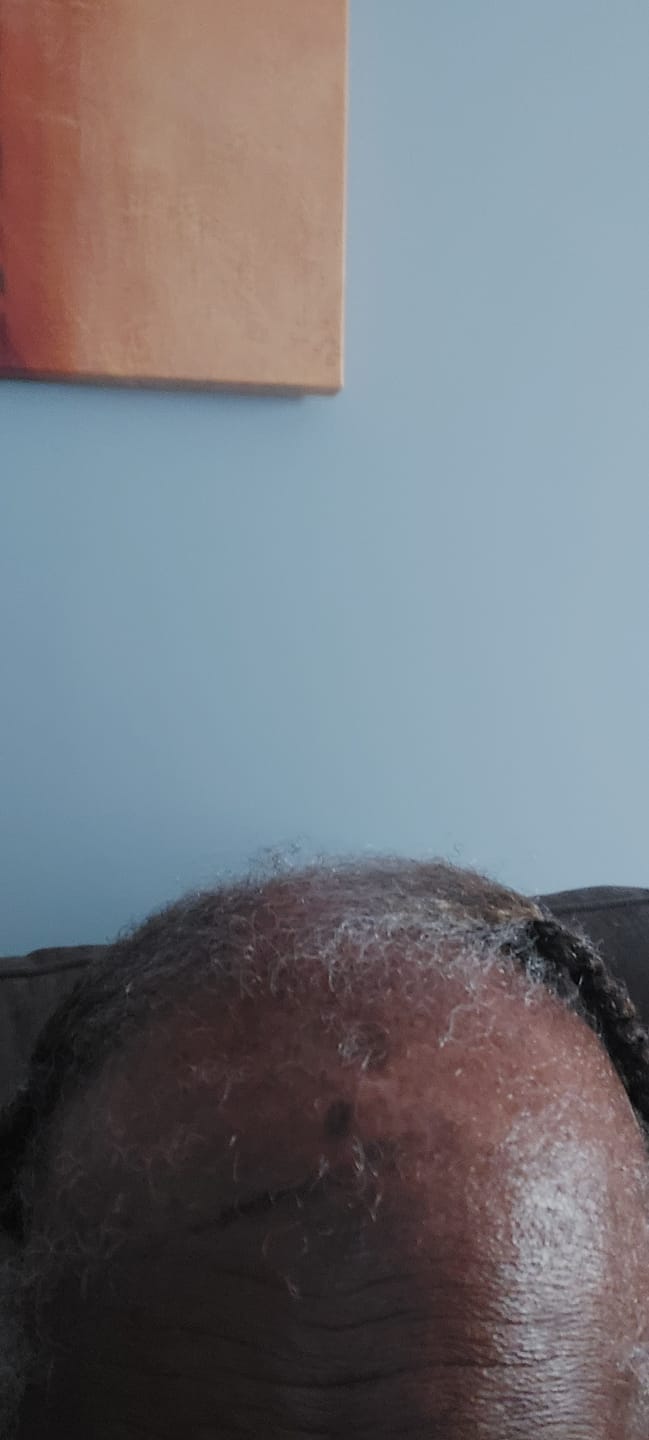 Customer photo review of The Scalp System