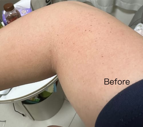 Customer photo review of Ulike 超光炮Pro美容儀-裕美限時團購