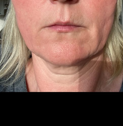 Customer photo review of SkinPro 2.0 - 4-i-1 Hudplejestav med rødlysterapi (Inkl. gratis serum)