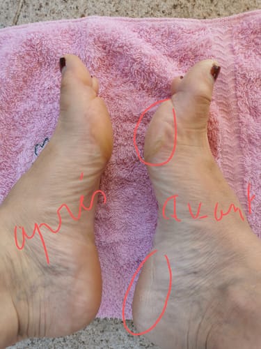 Customer photo review of LOVASKIN INSTANT FOOT PEEL Discovery Kit - Over 8 Beauty pedicure treatments