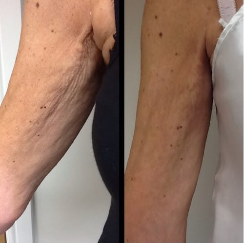 Customer photo review of AT Labs™ Стягащ Крем За Ръце