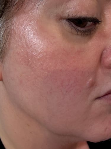 Customer photo review of JOVS Blacken Pro DPL Photofacial Skincare Device