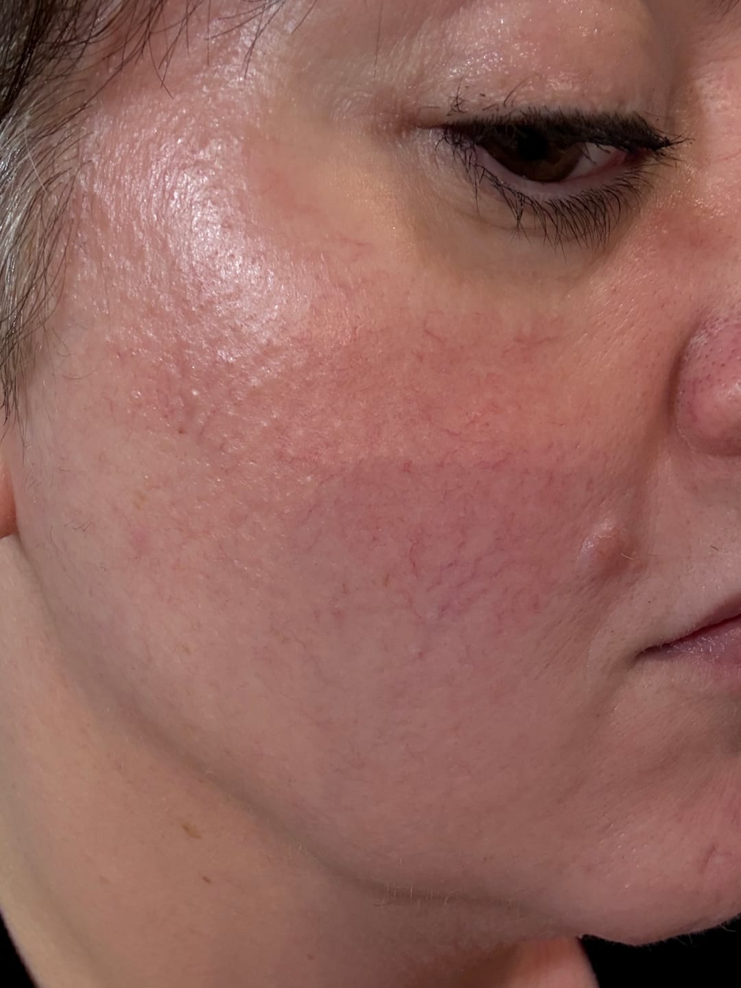 Customer photo review of JOVS Blacken Pro DPL Photofacial Skincare Device