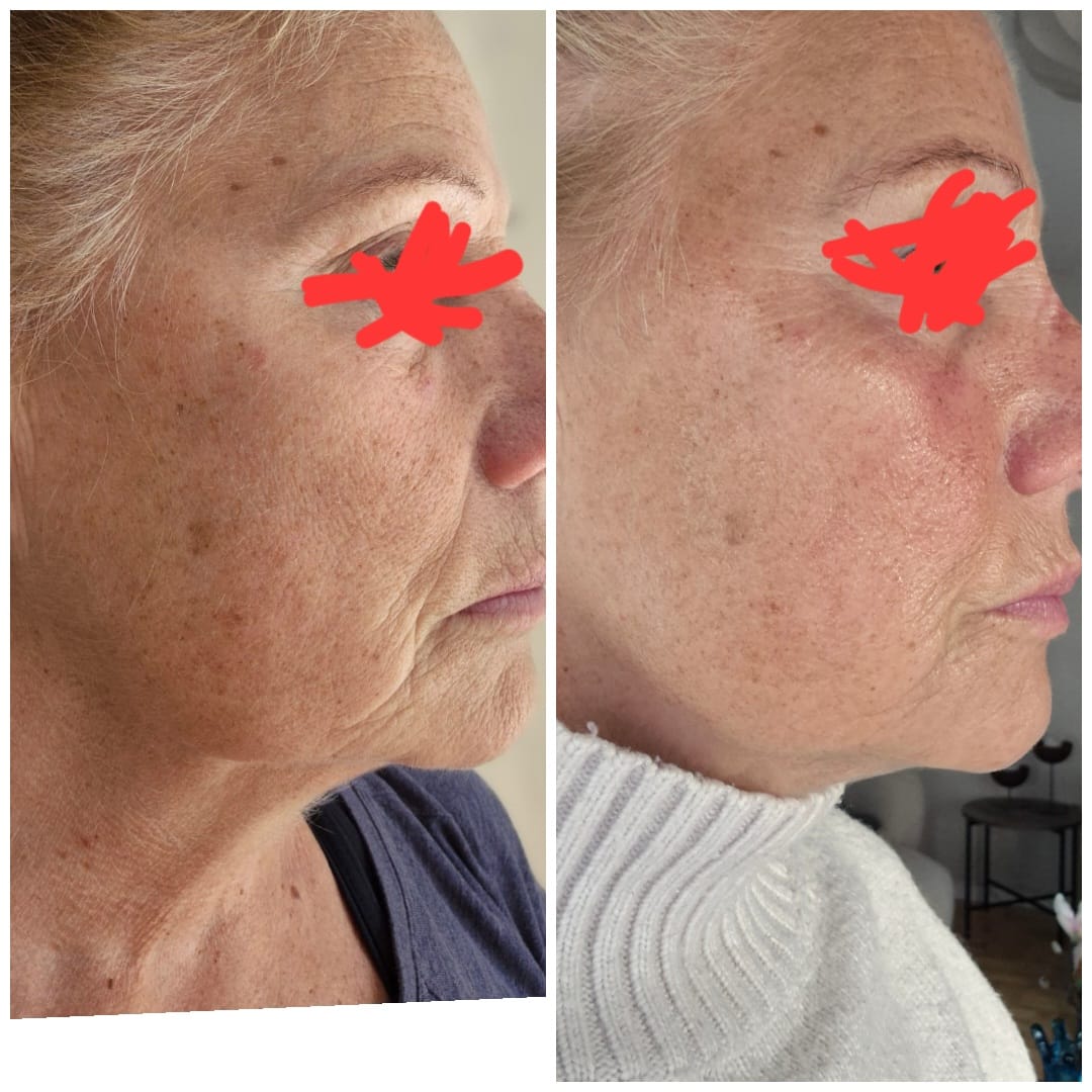Customer photo review of Skinboosting LED mask