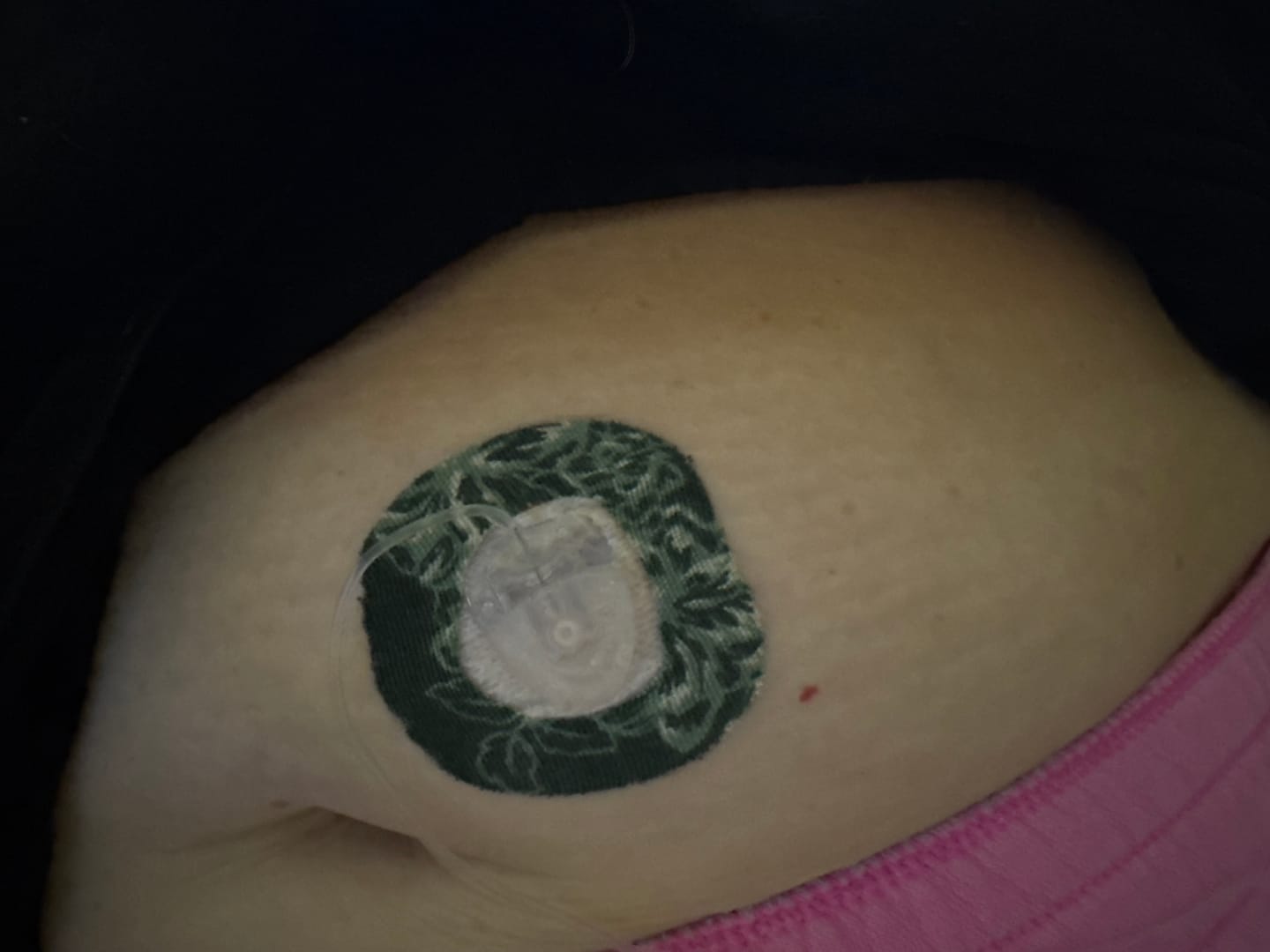 Customer photo review of Skin Grip Original - Dexcom G7 & Stelo Adhesive Patches (With Cutout)