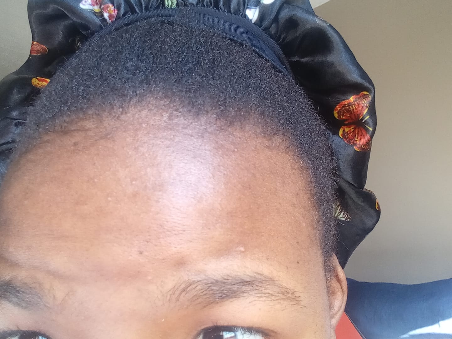 Customer photo review of New Formula: Hairline Fortifying Serum 30ml
