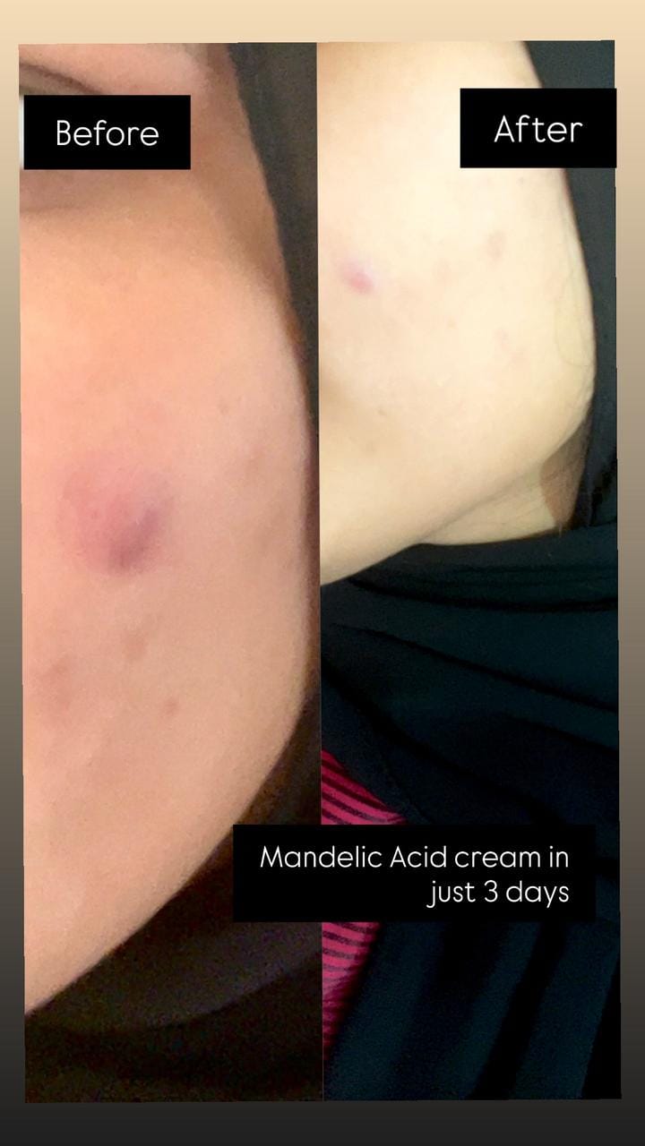 Customer photo review of Anti Acne Cream (Mandelic Acid 7%)