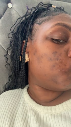 Customer photo review of Anti-Acne & Dark Spots African Soap