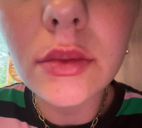Customer photo review of COSTIQ® EXTREME LIP PLUMPER