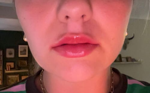Customer photo review of COSTIQ® EXTREME LIP PLUMPER