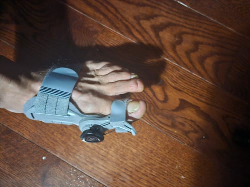 Customer photo review of Treatmedy™ Bunion Fix - Natural At-Home Bunion Relief