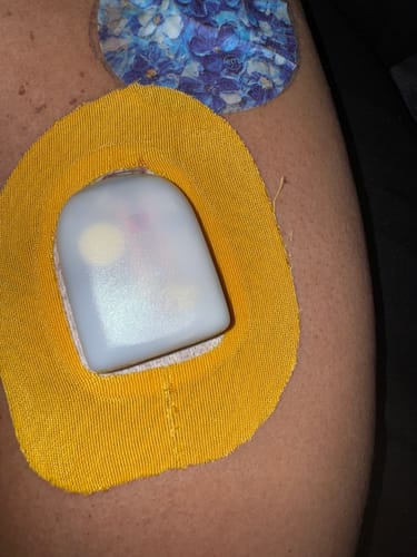 Customer photo review of Skin Grip Original - Omnipod Adhesive Patches