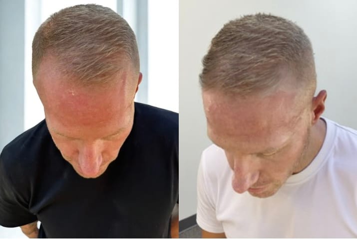 Customer photo review of LIVDOR Pro Laser Hair Growth Cap