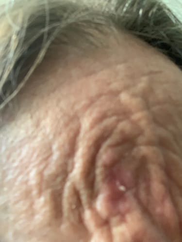 Customer photo review of ScarRelief™ | Silikon-Narbenpflaster