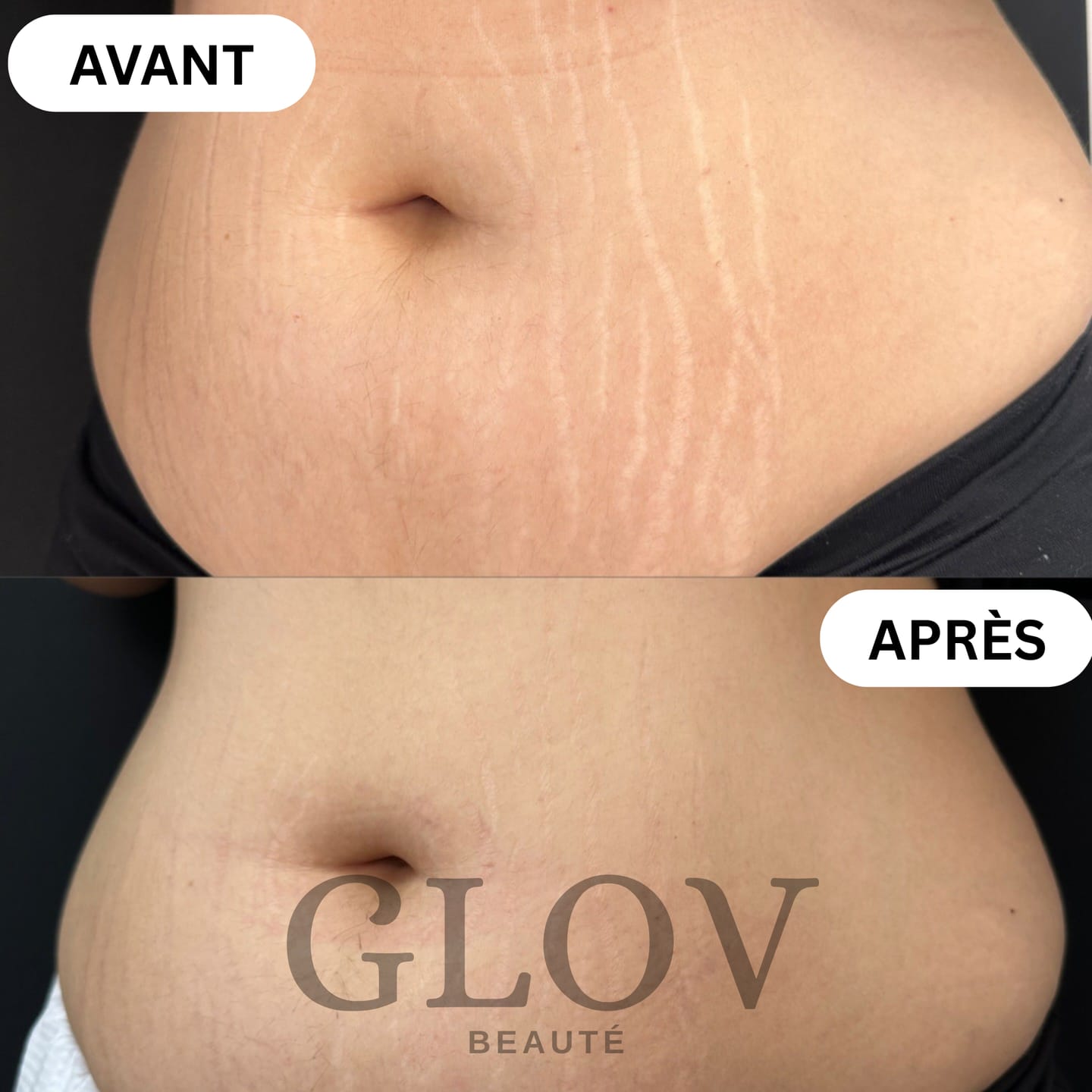Customer photo review of Kit Glov Beauté Vergeture