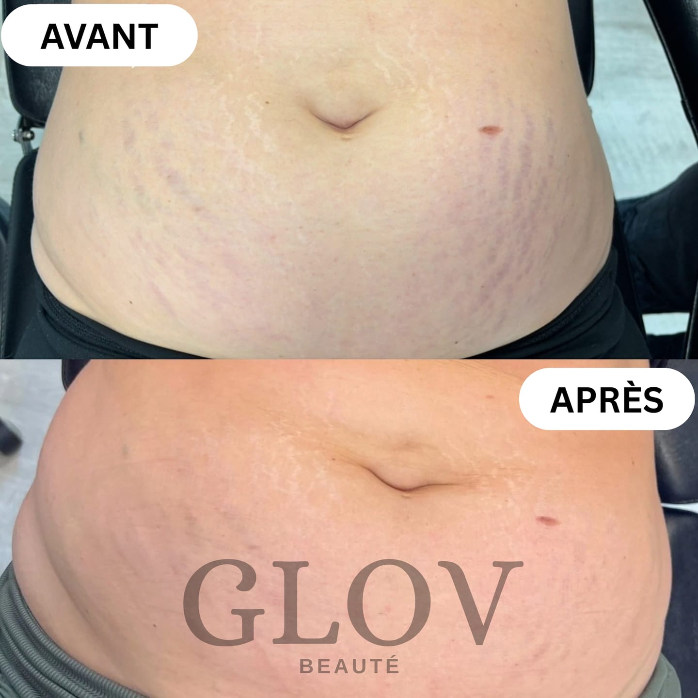 Customer photo review of Kit Glov Beauté Vergeture