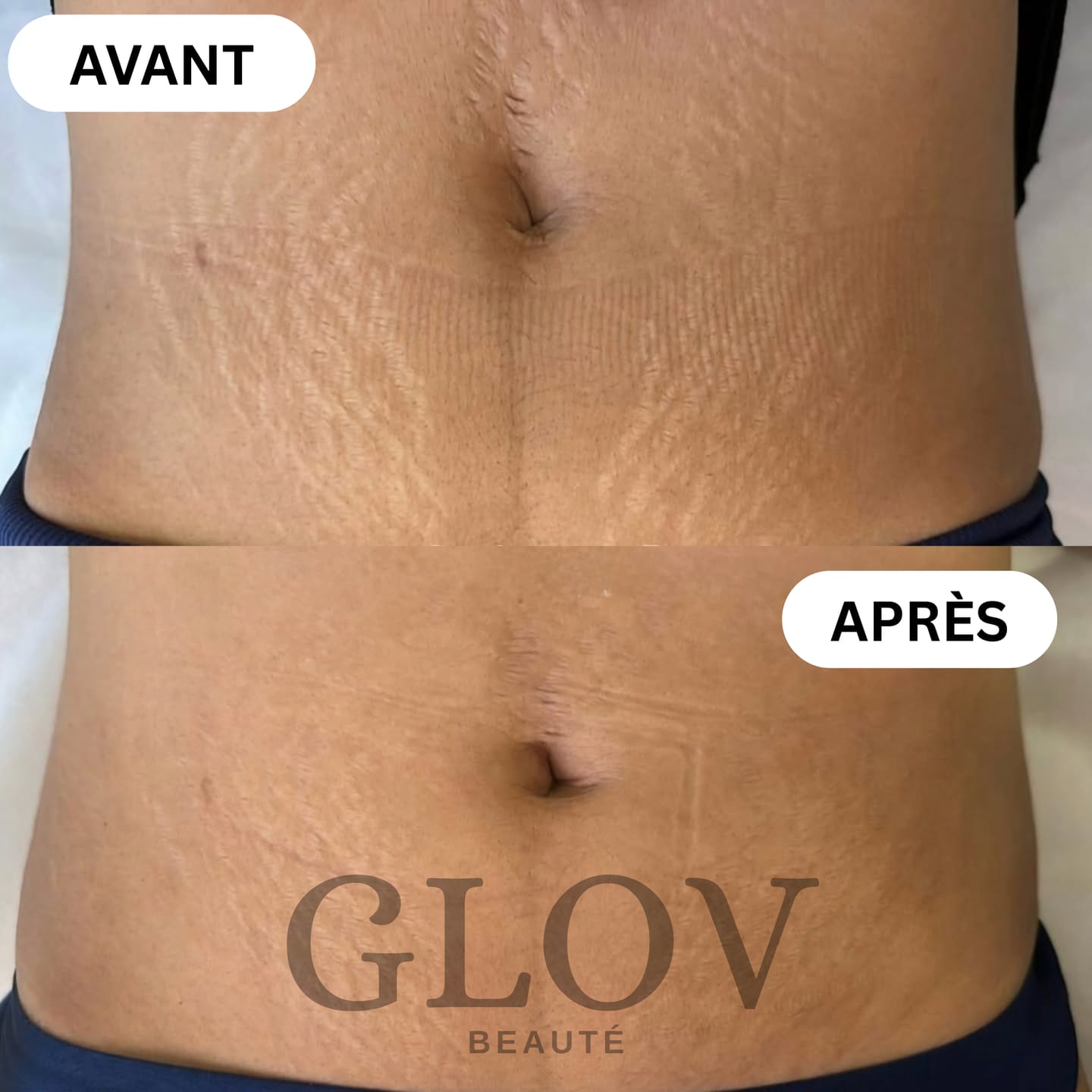 Customer photo review of Kit Glov Beauté Vergeture